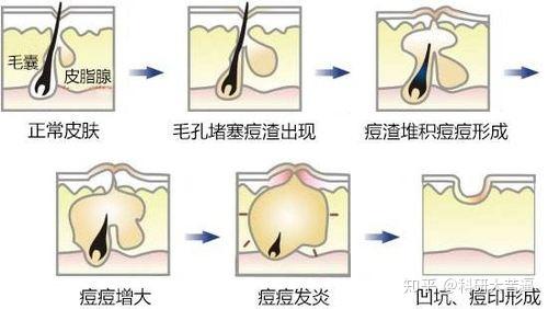 挑痘痘有什么害处吗？