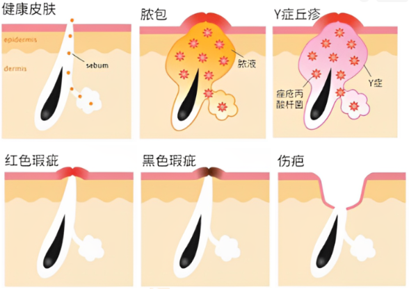 祛痘科普_科学祛痘方法,无痘肌肤不是梦!_痘痘祛痘